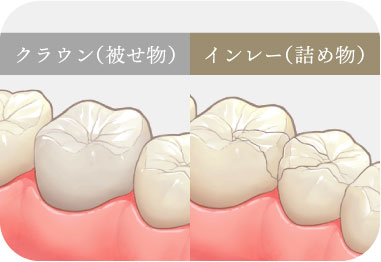 e.max（クラウン / インレー）